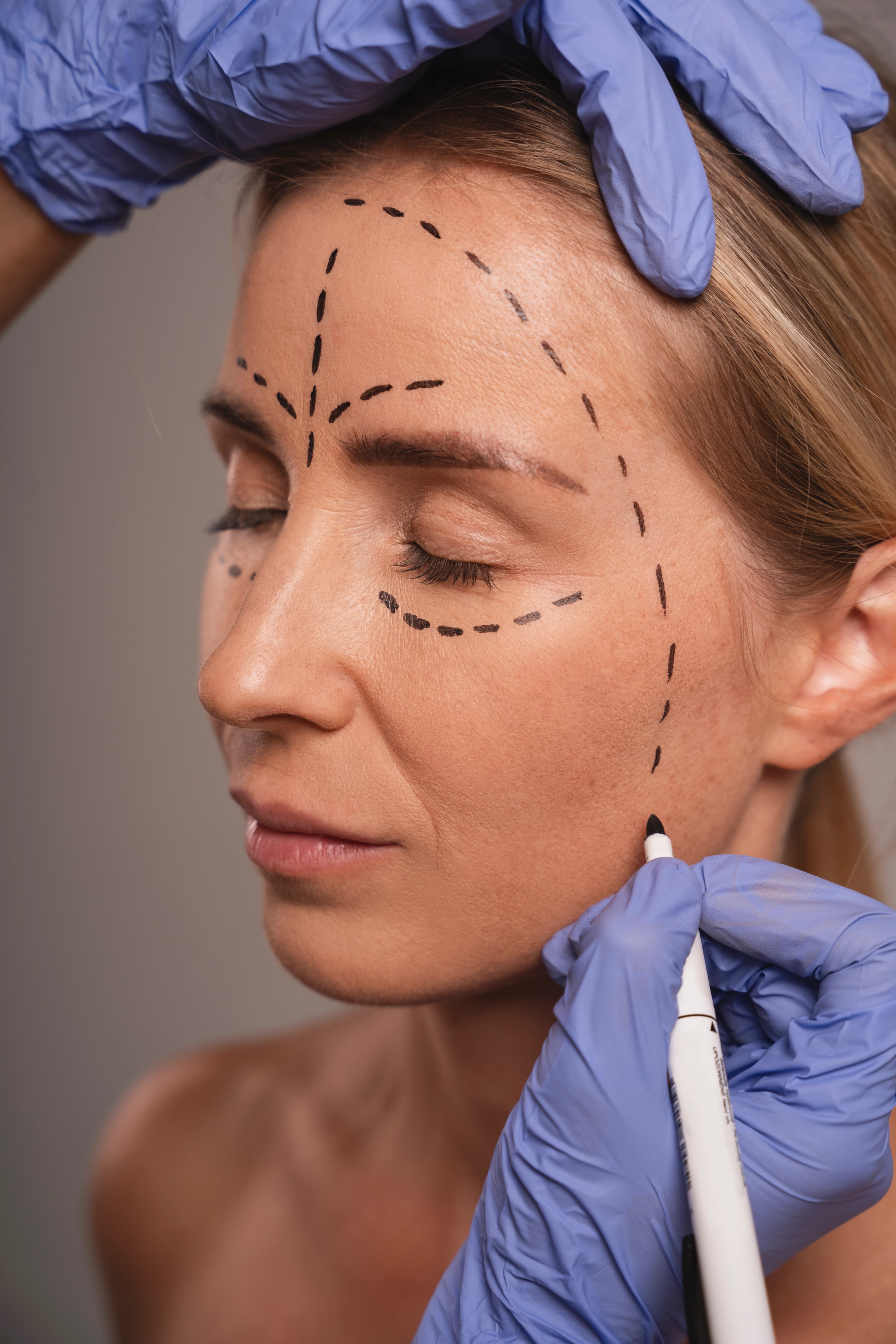 ENDOLIFT NON-SURGICAL