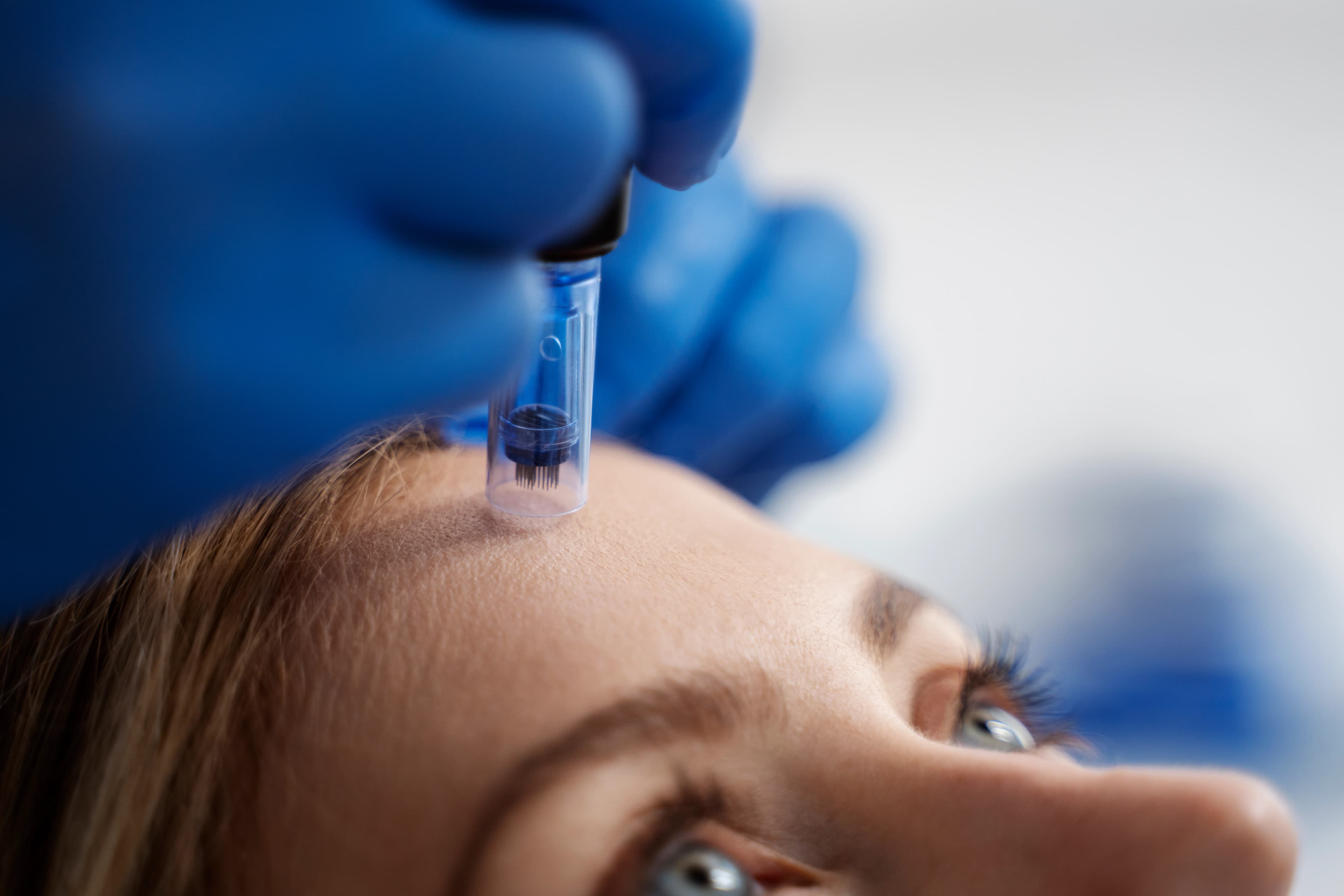 PRP + MICRONEEDLING